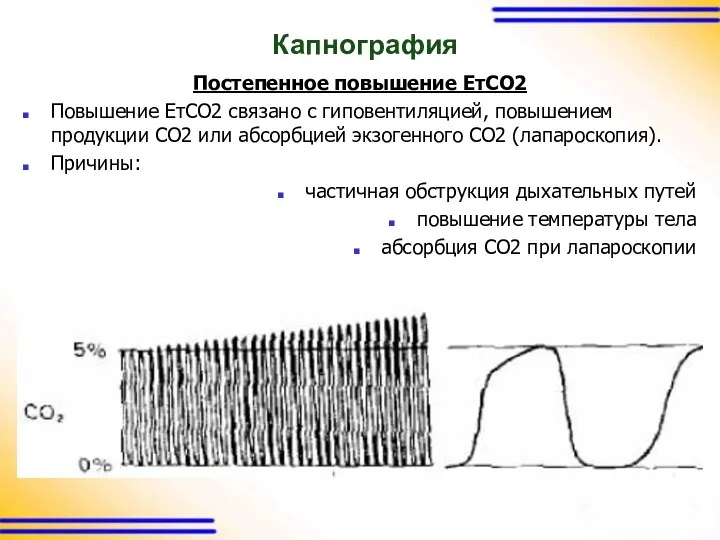 Капнография Постепенное повышение ЕтСО2 Повышение ЕтСО2 связано с гиповентиляцией, повышением продукции СО2 или