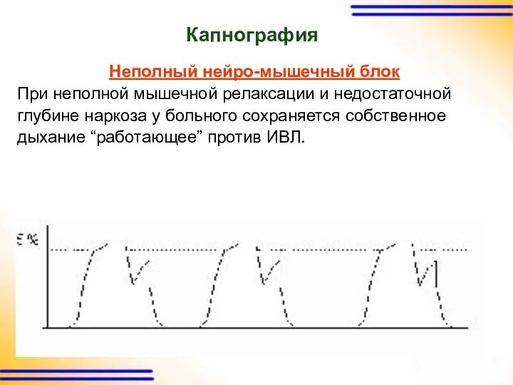 Капнография Неполный нейро-мышечный блок При неполной мышечной релаксации и недостаточной глубине наркоза у