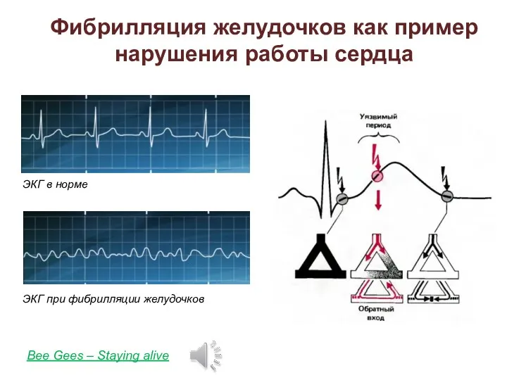Bee Gees – Staying alive Фибрилляция желудочков как пример нарушения