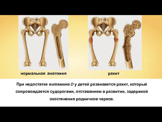 При недостатке витамина D у детей развивается рахит, который сопровождается