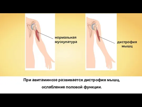 При авитаминозе развивается дистрофия мышц, ослабление половой функции.