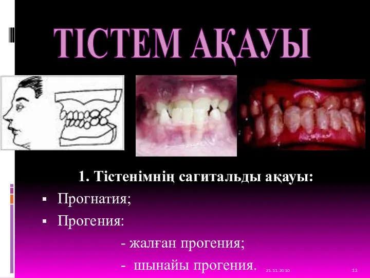 1. Тістенімнің сагитальды ақауы: Прогнатия; Прогения: - жалған прогения; - шынайы прогения. 21.11.2010 ТІСТЕМ АҚАУЫ