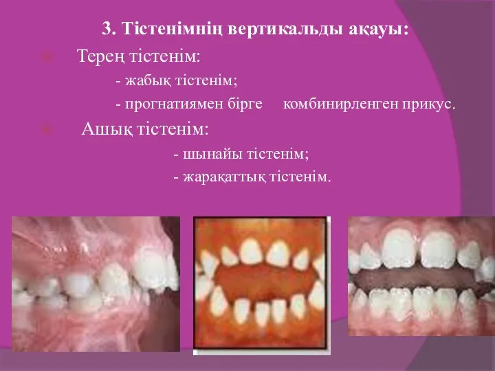 3. Тістенімнің вертикальды ақауы: Терең тістенім: - жабық тістенім; -