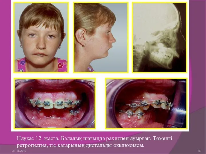 Науқас 12 жаста. Балалық шағында рахитпен ауырған. Төменгі ретрогнатия, тіс қатарының дистальды окклюзиясы. 21.11.2010