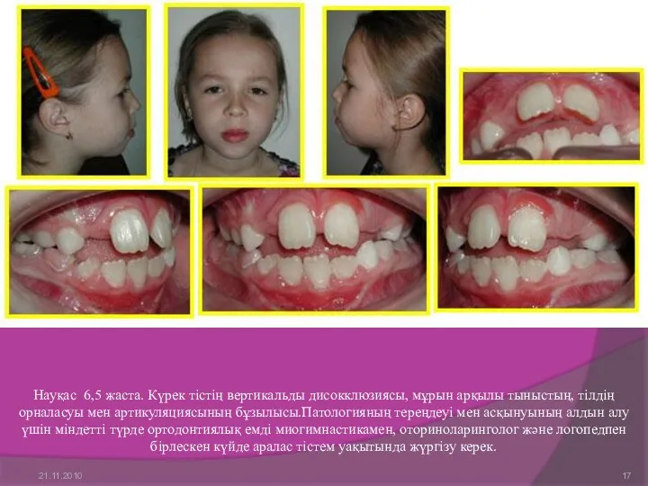 Науқас 6,5 жаста. Күрек тістің вертикальды дисокклюзиясы, мұрын арқылы тыныстың,