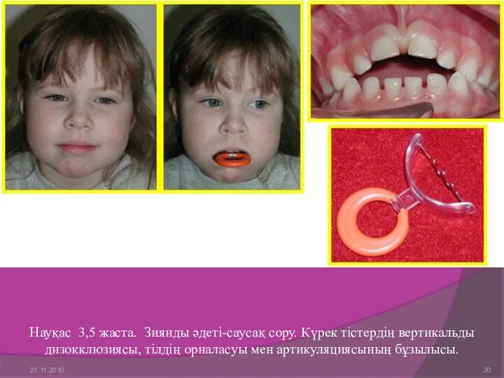 Науқас 3,5 жаста. Зиянды әдеті-саусақ сору. Күрек тістердің вертикальды дизокклюзиясы, тілдің орналасуы мен артикуляциясының бұзылысы. 21.11.2010