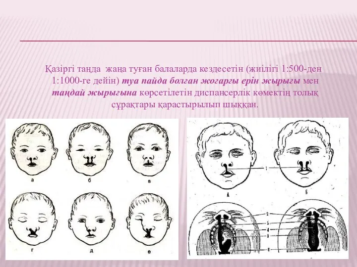 Қазіргі таңда жаңа туған балаларда кездесетін (жиілігі 1:500-ден 1:1000-ге дейін)