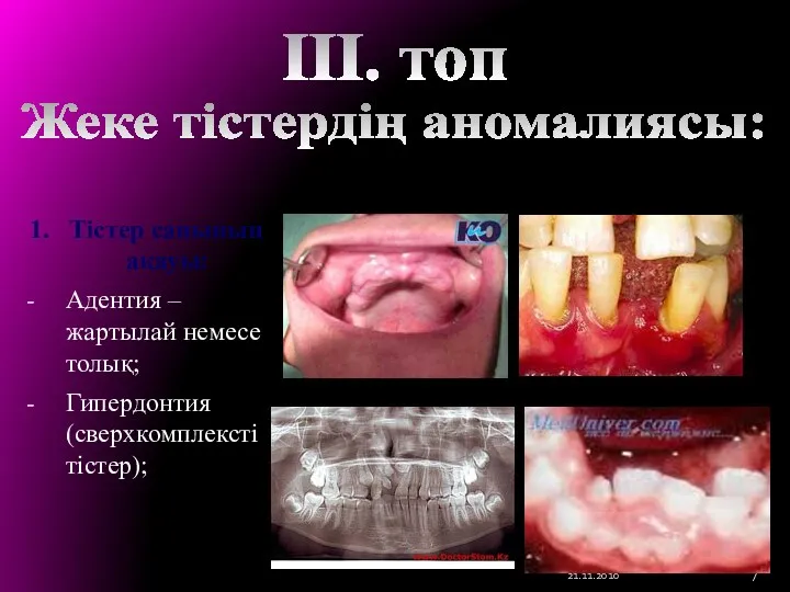 1. Тістер санының ақауы: Адентия – жартылай немесе толық; Гипердонтия