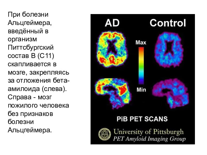 При болезни Альцгеймера, введённый в организм Питтсбургский состав B (С11) скапливается в мозге,