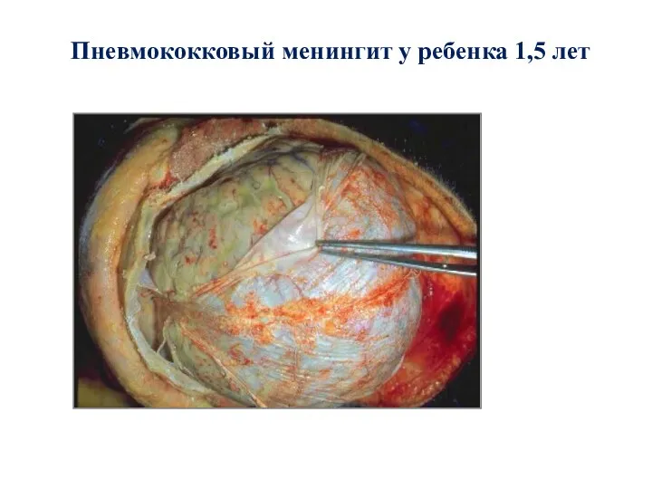 Пневмококковый менингит у ребенка 1,5 лет