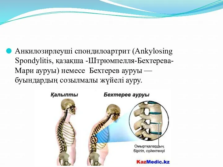 Анкилозирлеуші спондилоартрит (Ankylosing Spondylitis, қазақша -Штрюмпелля-Бехтерева-Мари ауруы) немесе Бехтерев ауруы — буындардың созылмалы жүйелі ауру.