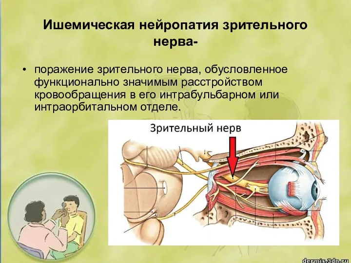 Ишемическая нейропатия зрительного нерва- поражение зрительного нерва, обусловленное функционально значимым