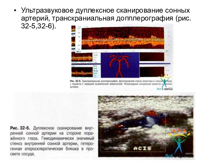 Ультразвуковое дуплексное сканирование сонных артерий, транскраниальная допплерография (рис. 32-5,32-6).