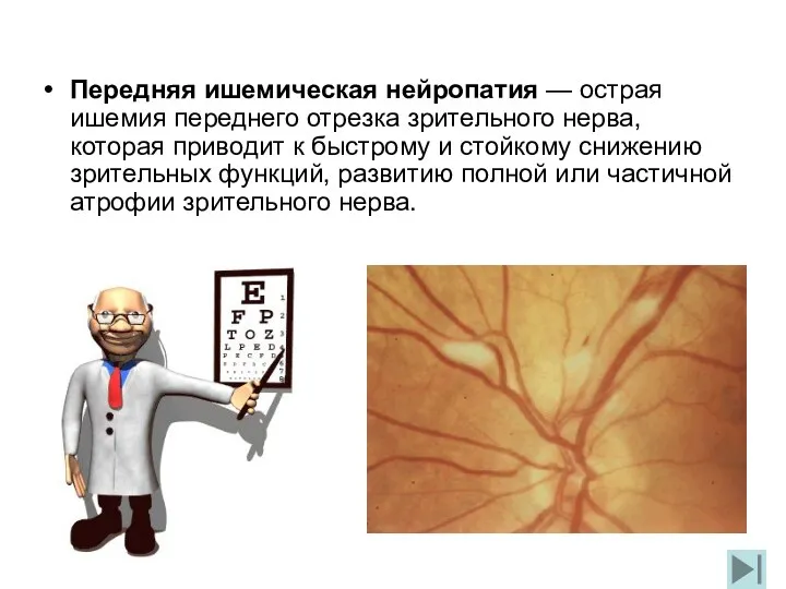 Передняя ишемическая нейропатия — острая ишемия переднего отрезка зрительного нерва,