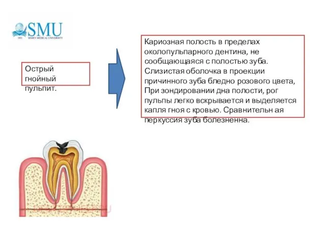 Острый гнойный пульпит. Кариозная полость в пределах околопульпарного дентина, не