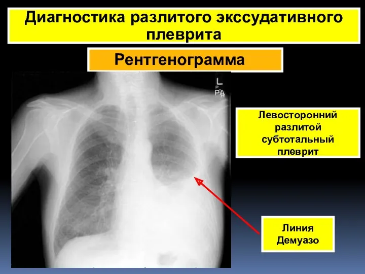 Рентгенограмма Диагностика разлитого экссудативного плеврита Левосторонний разлитой субтотальный плеврит Линия Демуазо