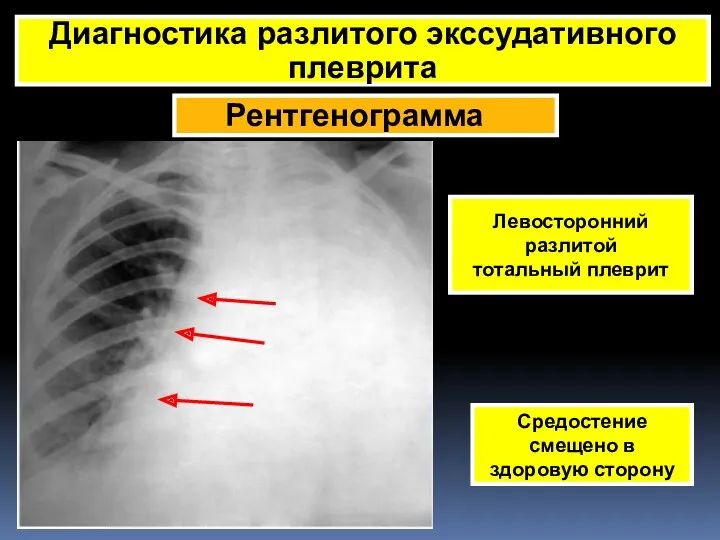 Рентгенограмма Диагностика разлитого экссудативного плеврита Левосторонний разлитой тотальный плеврит Средостение смещено в здоровую сторону