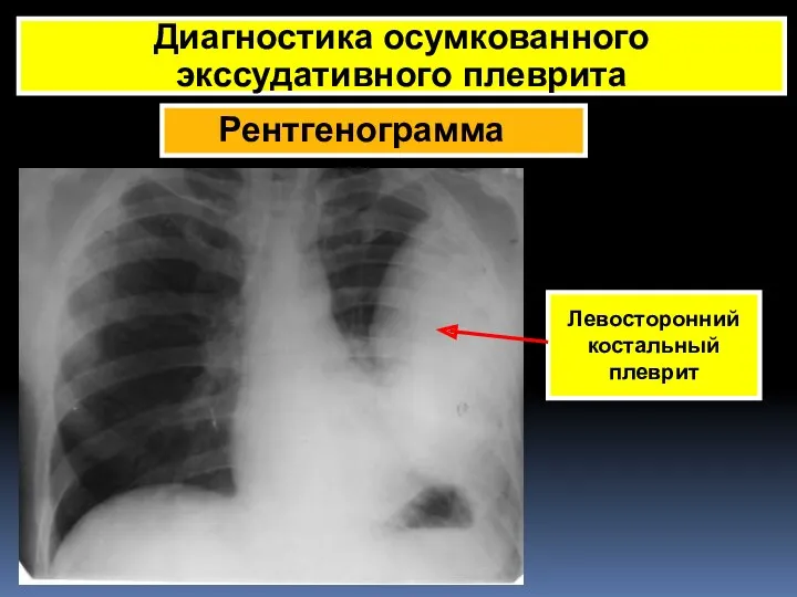 Рентгенограмма Диагностика осумкованного экссудативного плеврита Левосторонний костальный плеврит