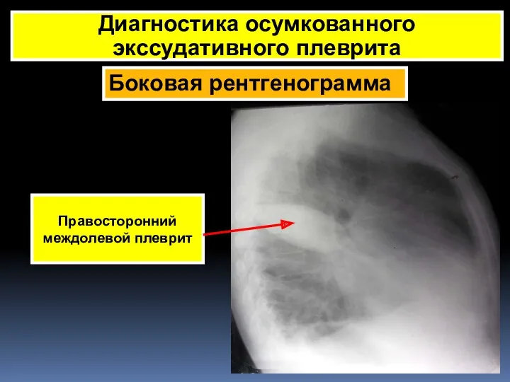 Боковая рентгенограмма Диагностика осумкованного экссудативного плеврита Правосторонний междолевой плеврит