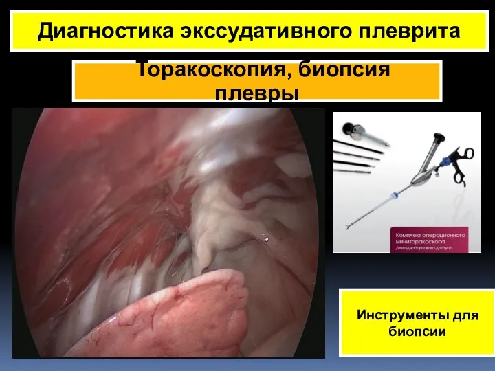 Торакоскопия, биопсия плевры Диагностика экссудативного плеврита Инструменты для биопсии