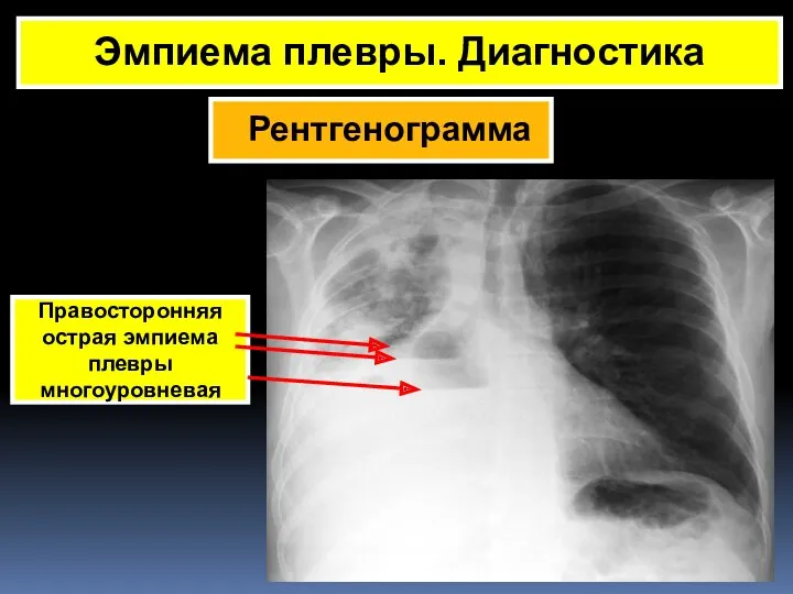 Рентгенограмма Эмпиема плевры. Диагностика Правосторонняя острая эмпиема плевры многоуровневая