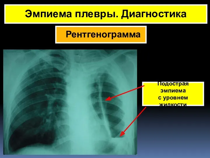 Рентгенограмма Эмпиема плевры. Диагностика Подострая эмпиема с уровнем жидкости