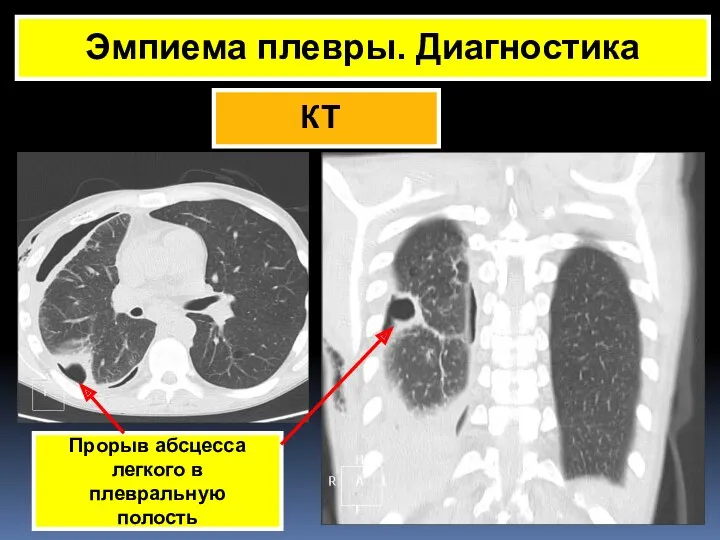 КТ Эмпиема плевры. Диагностика Прорыв абсцесса легкого в плевральную полость