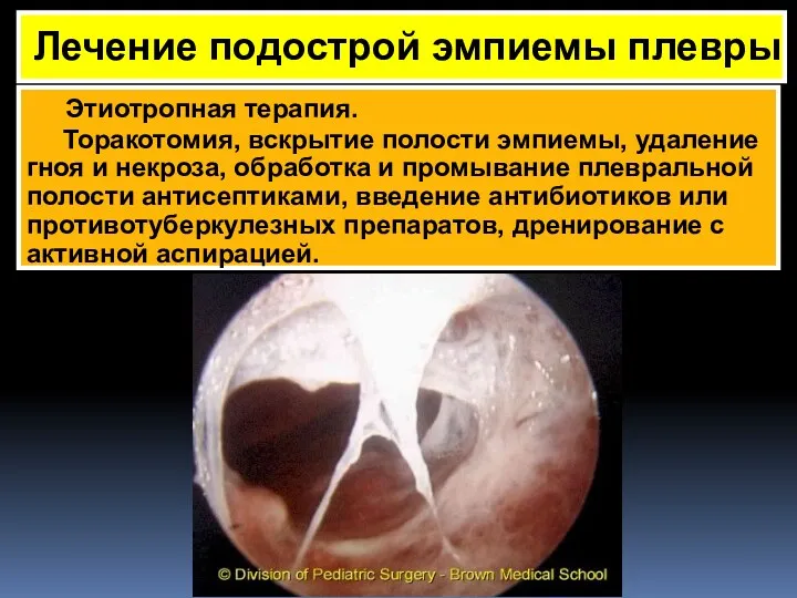 Лечение подострой эмпиемы плевры Этиотропная терапия. Торакотомия, вскрытие полости эмпиемы,