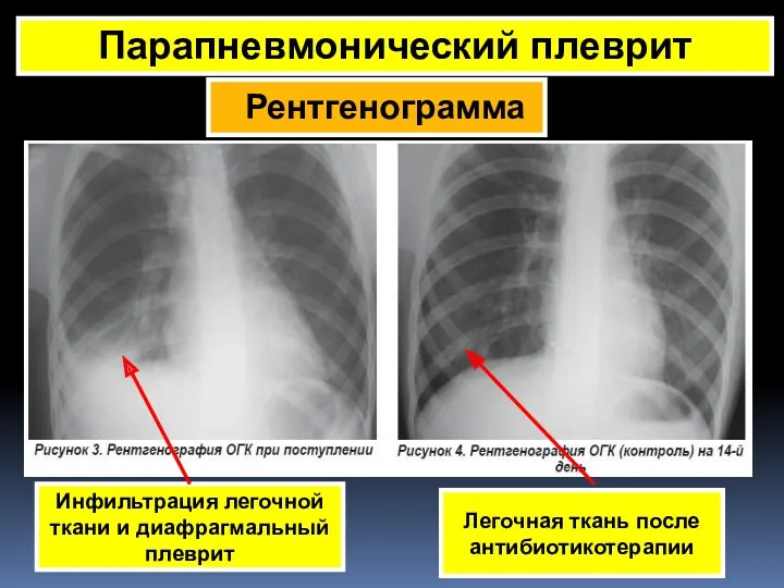 Парапневмонический плеврит Инфильтрация легочной ткани и диафрагмальный плеврит Легочная ткань после антибиотикотерапии Рентгенограмма