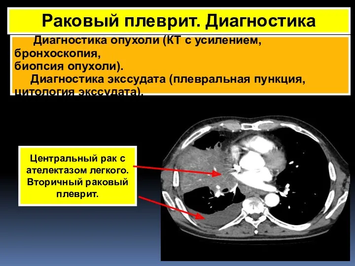 Раковый плеврит. Диагностика Диагностика опухоли (КТ с усилением, бронхоскопия, биопсия