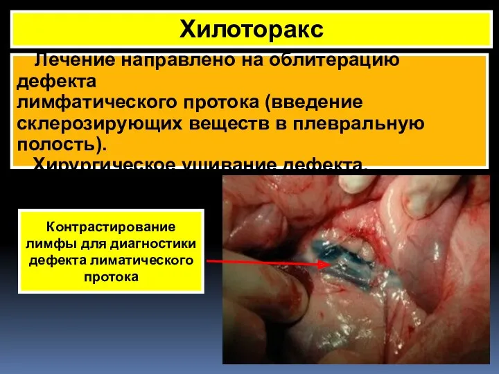 Хилоторакс Лечение направлено на облитерацию дефекта лимфатического протока (введение склерозирующих