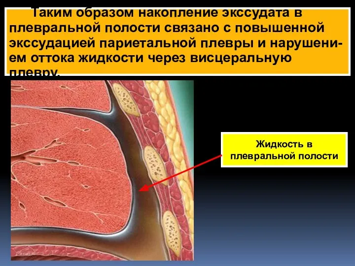 Таким образом накопление экссудата в плевральной полости связано с повышенной