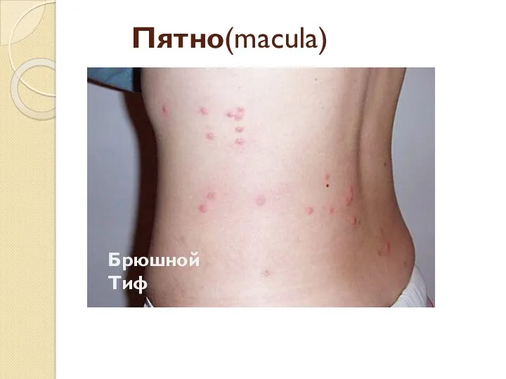 Пятно(macula) Брюшной Тиф