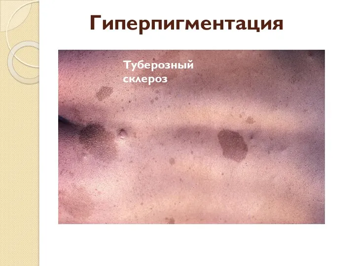 Гиперпигментация Туберозный склероз