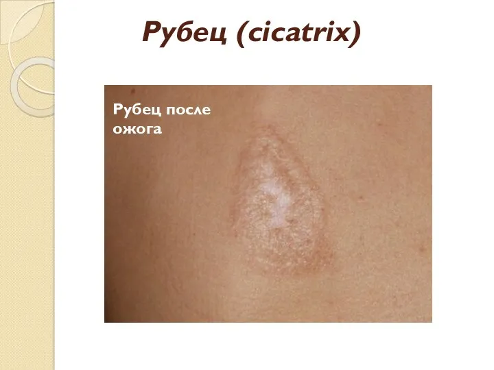 Рубец (cicatrix) Рубец после ожога