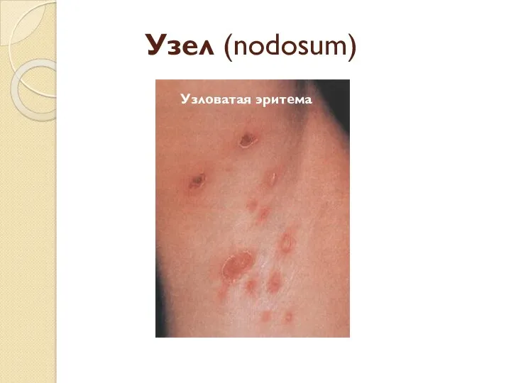 Узел (nodosum) Узловатая эритема