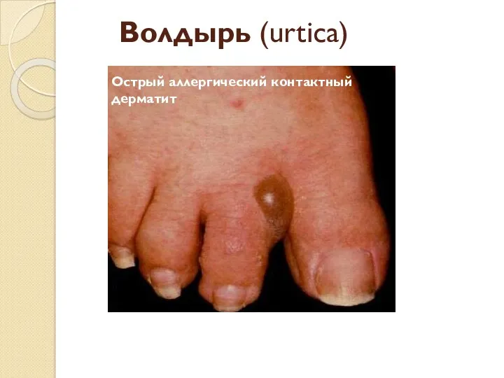 Волдырь (urtica) Острый аллергический контактный дерматит