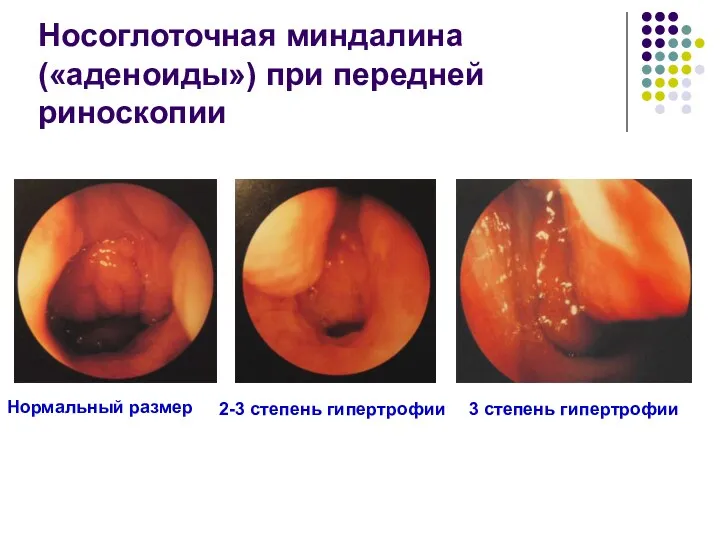 Носоглоточная миндалина («аденоиды») при передней риноскопии Нормальный размер 2-3 степень гипертрофии 3 степень гипертрофии