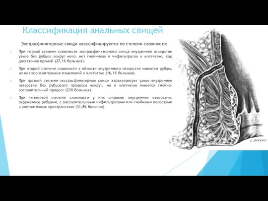 Экстрасфинктерные свищи классифицируются по степени сложности: При первой степени сложности