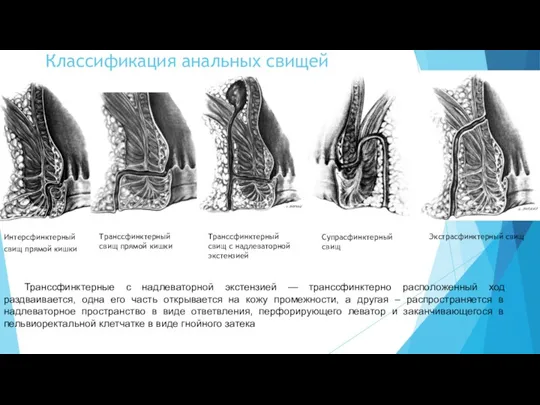 Классификация анальных свищей Интерсфинктерный свищ прямой кишки Транссфинктерный свищ прямой