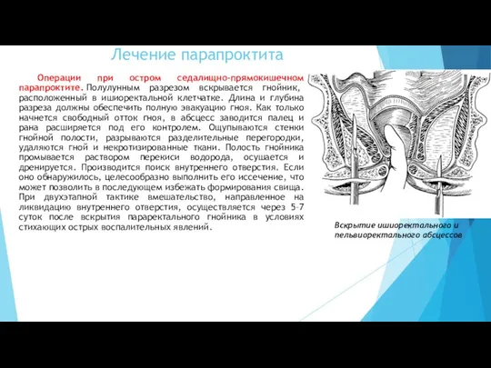 Операции при остром седалищно-прямокишечном парапроктите. Полулунным разрезом вскрывается гнойник, расположенный