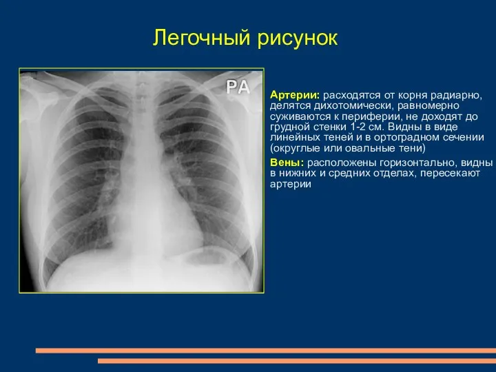 Легочный рисунок Артерии: расходятся от корня радиарно, делятся дихотомически, равномерно