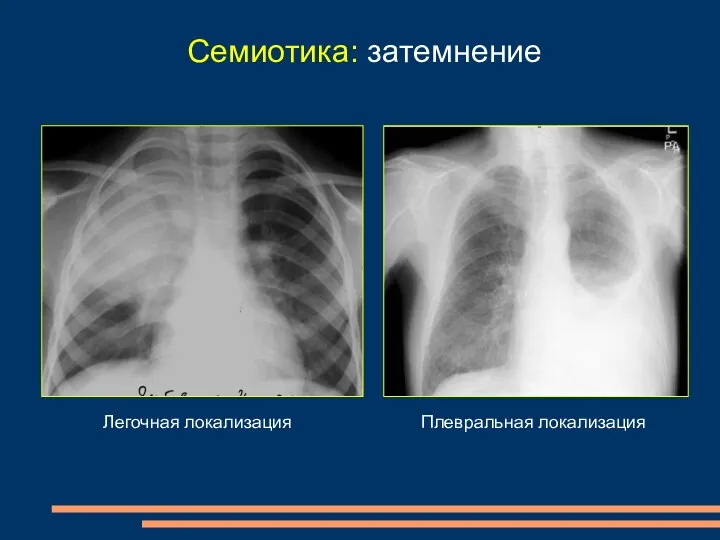 Семиотика: затемнение Легочная локализация Плевральная локализация