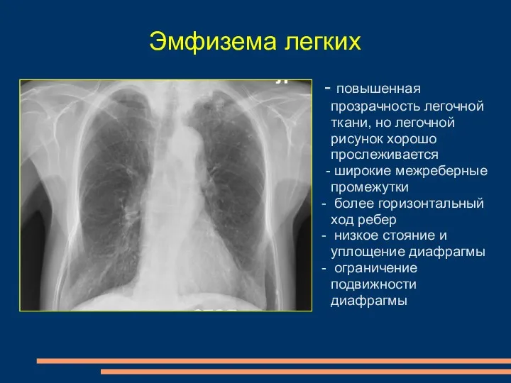 Эмфизема легких - повышенная прозрачность легочной ткани, но легочной рисунок