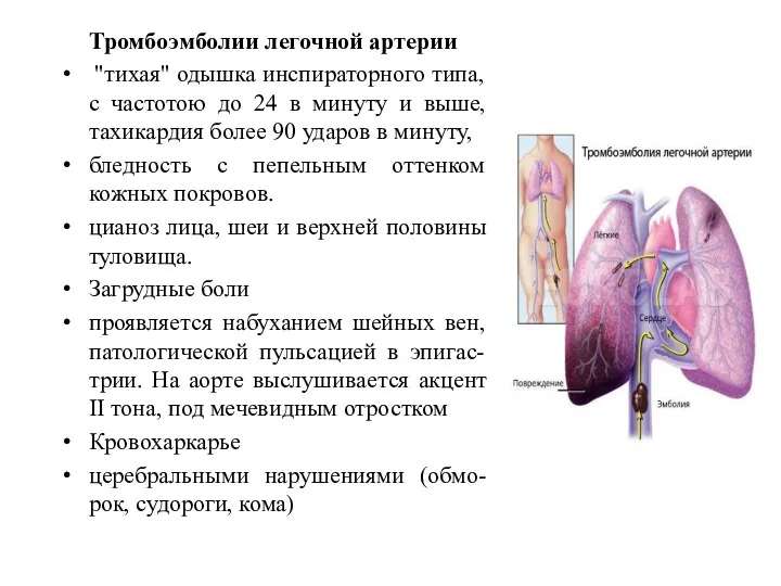 Тромбоэмболии легочной артерии "тихая" одышка инспираторного типа, с частотою до
