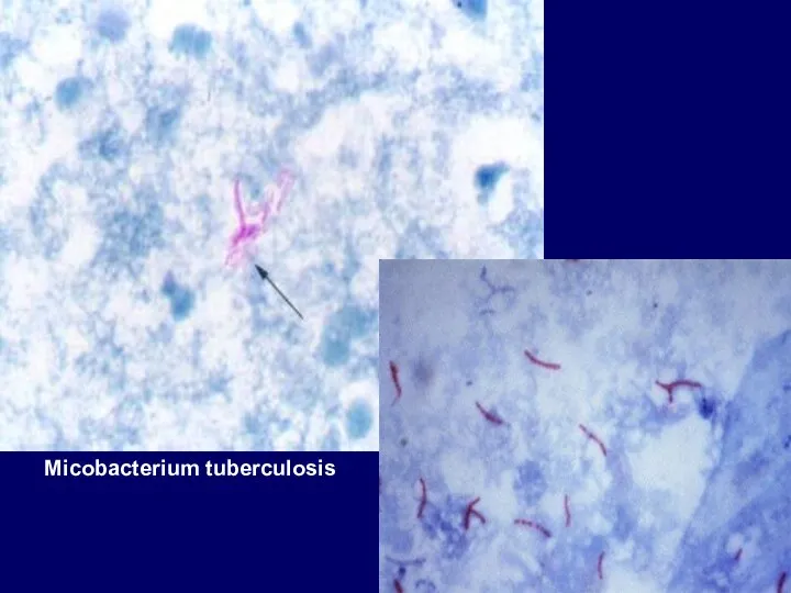 Micobacterium tuberculosis