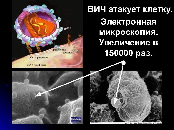 ВИЧ атакует клетку. Электронная микроскопия. Увеличение в 150000 раз.