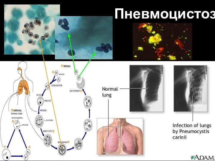 Пневмоцистоз