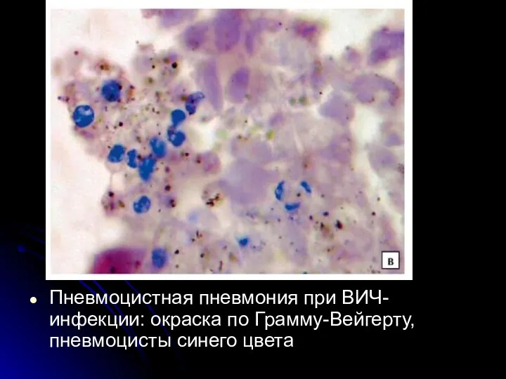 Пневмоцистная пневмония при ВИЧ-инфекции: окраска по Грамму-Вейгерту, пневмоцисты синего цвета