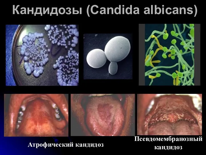 Кандидозы (Candida albicans) Атрофический кандидоз Псевдомембранозный кандидоз